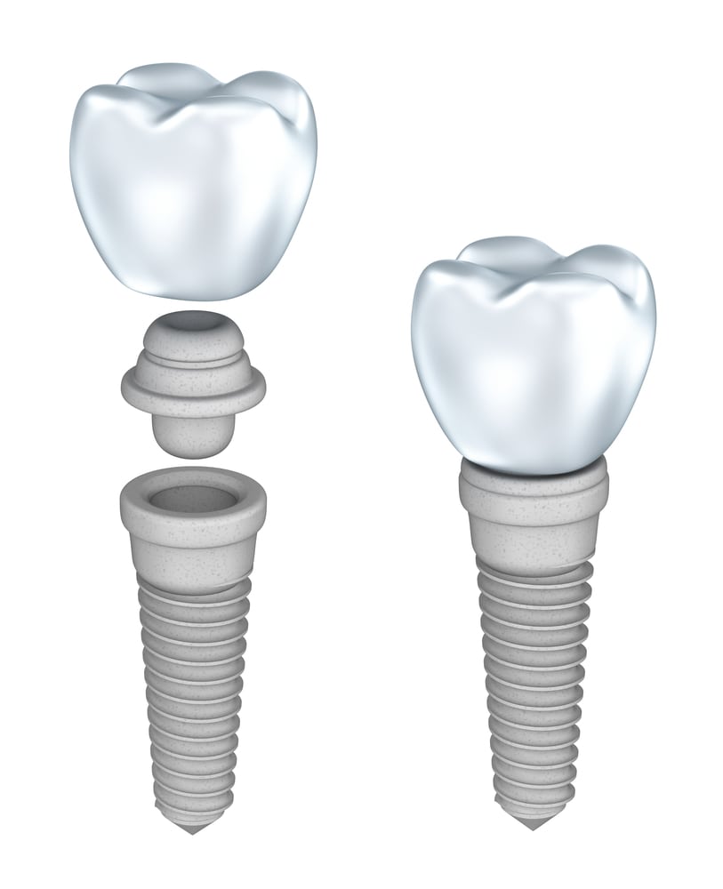 Dental Implants Sunshine Coast Northshore Dental