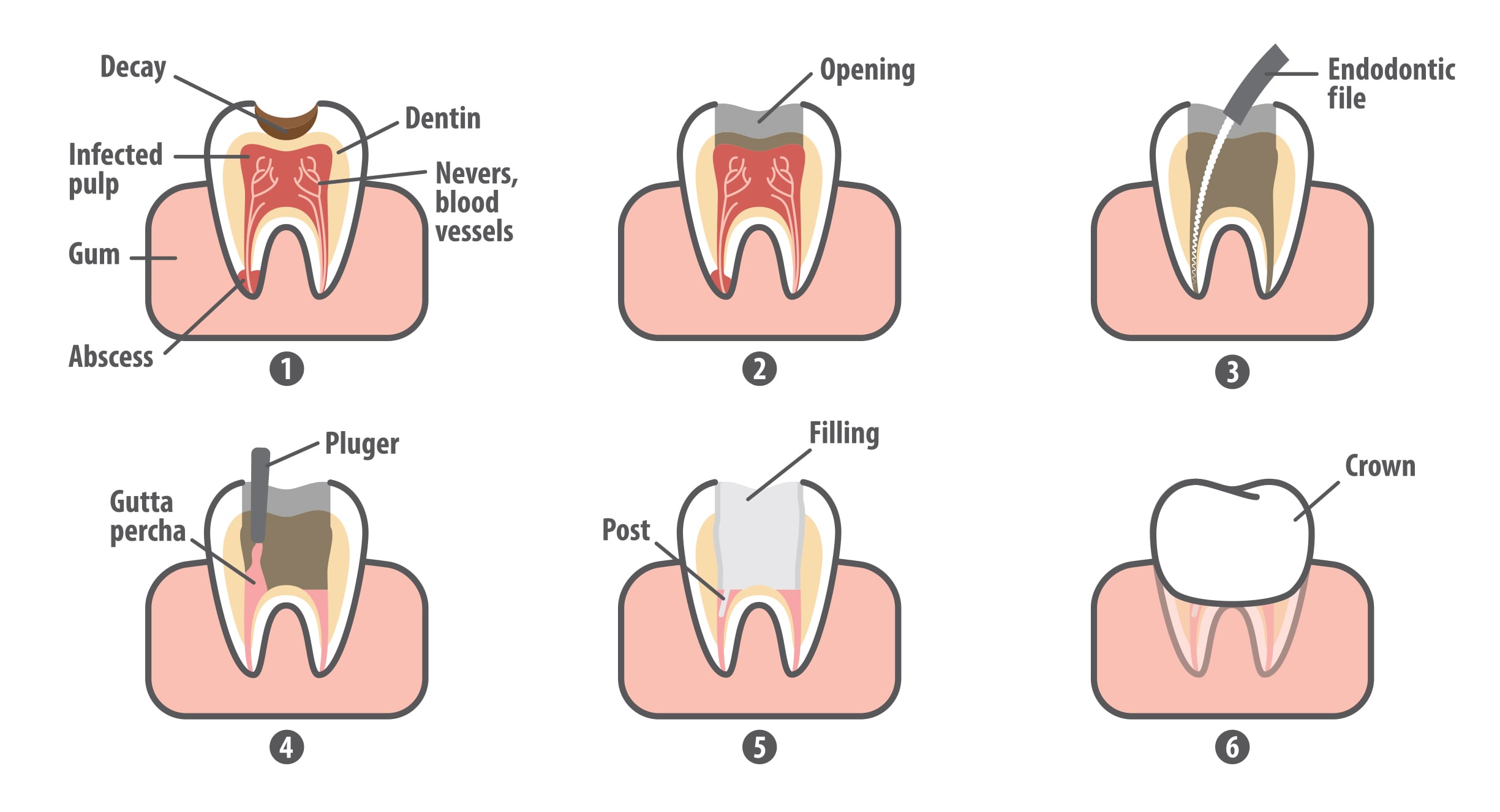 Root Canal Treatment Northshore Dental and Oral Health