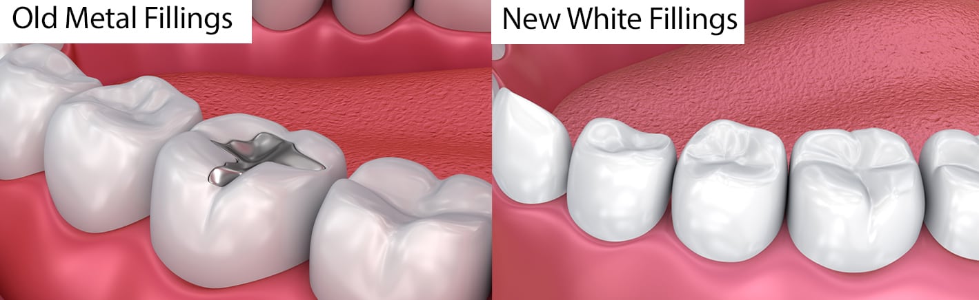 What is a Tooth Filling? White Tooth Fillings are Healthy and Durable