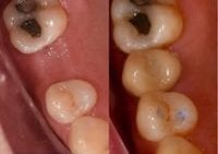 Non Invasive Implants!