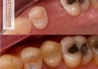 Non Invasive Implants!