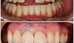 Implant Placement- Upper Front Tooth