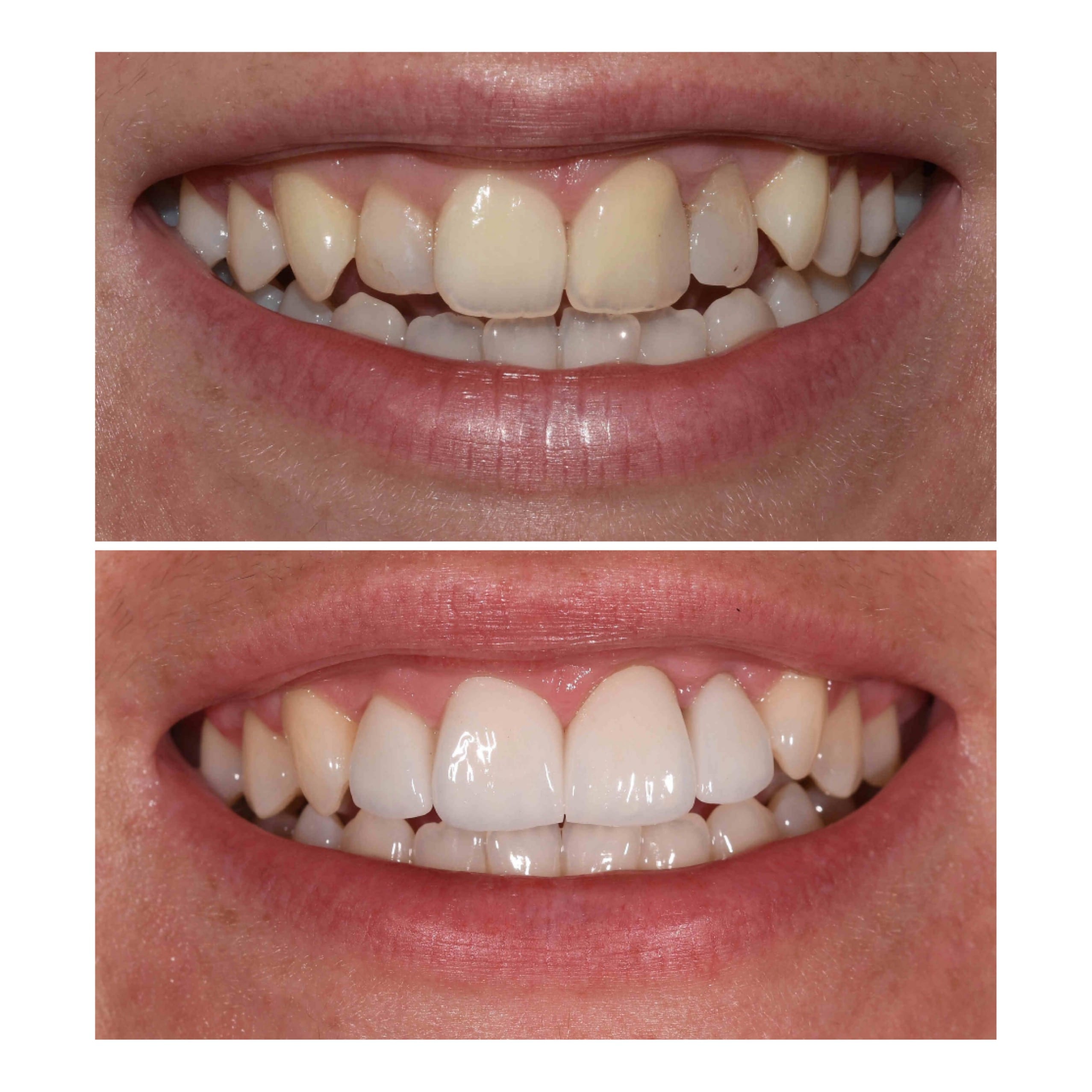 Dental Veneers Sunshine Coast Northshore Dental And Oral Health