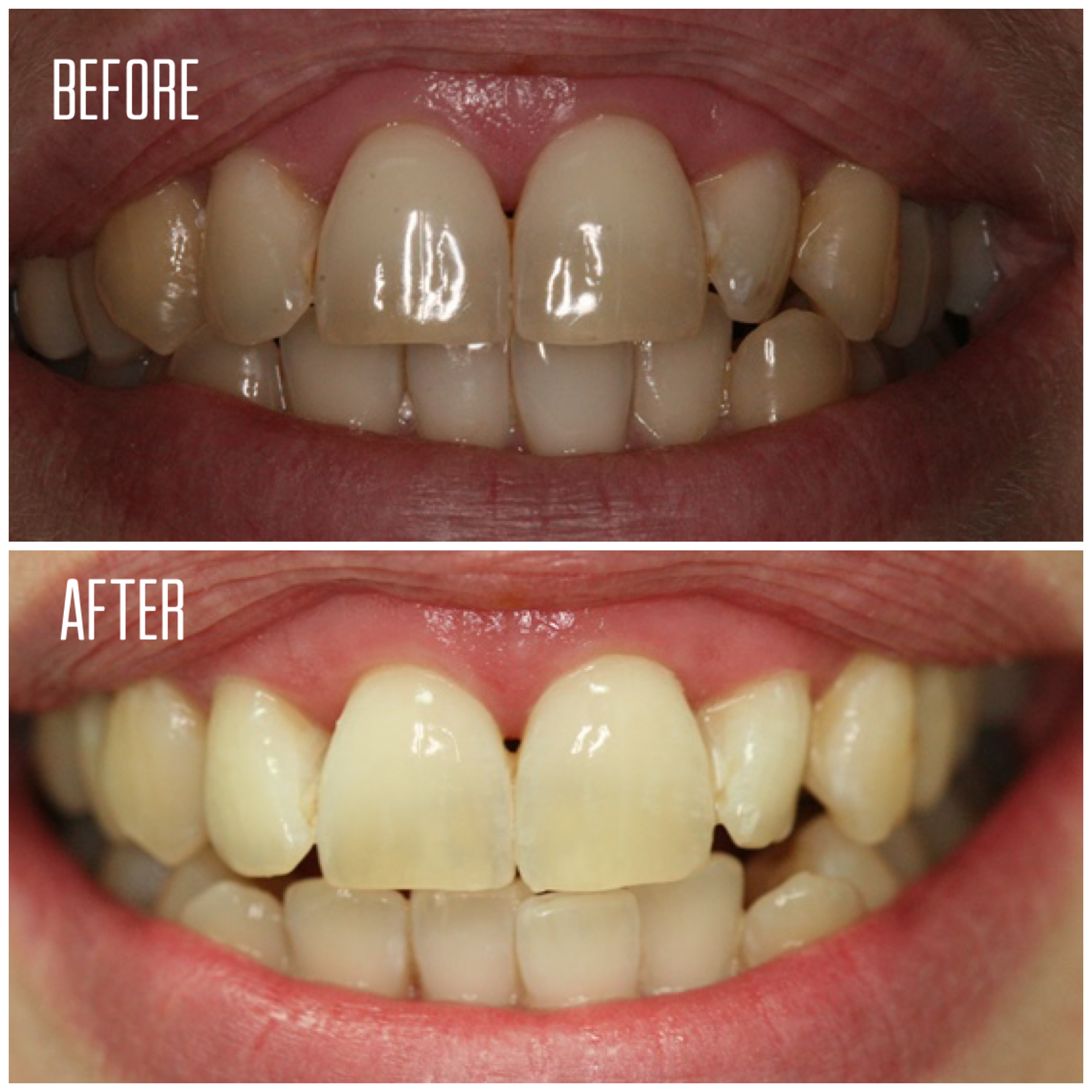 Whitening - Northshore Dental and Oral Health