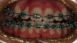 mild gingivitis with braces