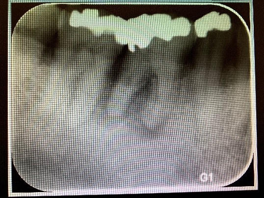 Periodontal disease (gum disease) - Northshore Dental and Oral Health