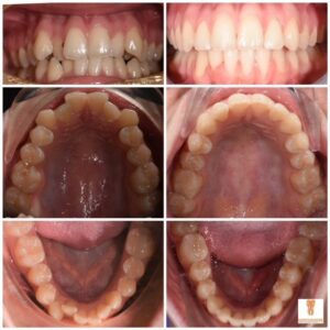 ORTHODONTIC  LOYALTY CARD 🦷 Cardholders will receive 50% off replacement retainers 