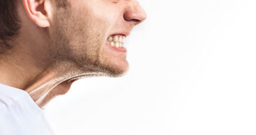 Bruxism or grinding clenching can cause a painful jaw & headaches