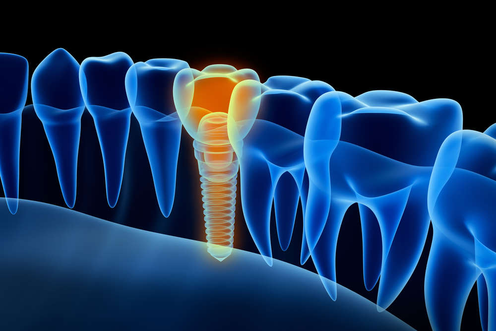 digital Implant plan
