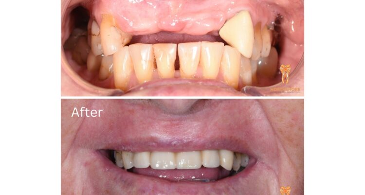 Can I use my superannuation for Dental Treatment?