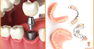 Replacing Missing Teeth: Dental Implants vs. Dentures with Northshore Dental