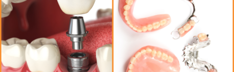 Replacing Missing Teeth: Dental Implants vs. Dentures