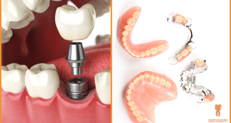 Replacing Missing Teeth: Dental Implants vs. Dentures with Northshore Dental