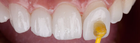Porcelain Veneers vs. Composite Bonding: