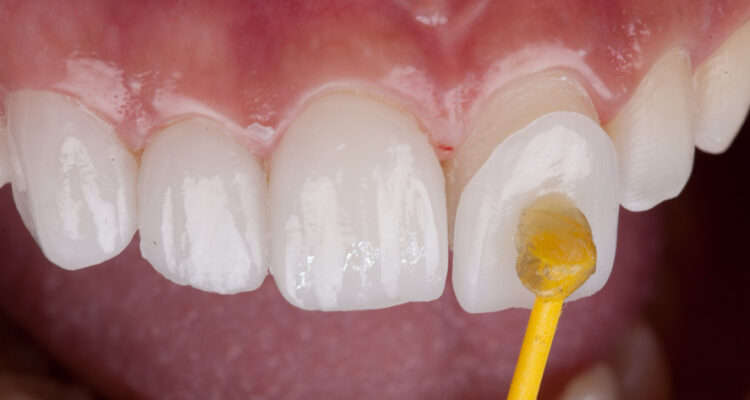 Porcelain Veneers vs. Composite Bonding: Which Is Right for You?