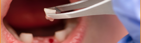 What To Do If a Tooth Is Knocked Out