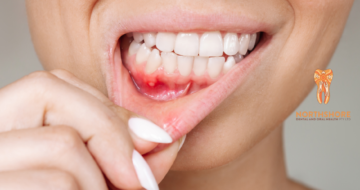 Why Bleeding Gums Are a Warning Sign You Shouldn’t Ignore
