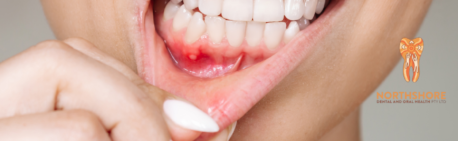 Why Bleeding Gums Are a Warning Sign You Shouldn’t Ignore