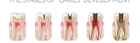 5 Stages of Tooth Decay